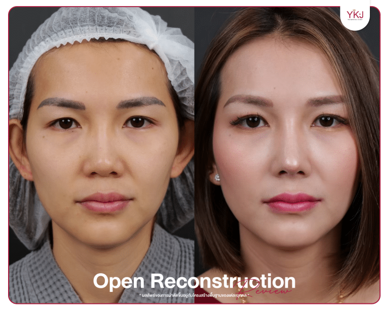 รีวิวแก้จมูก , รีวิวเสริมจมูกโอเพ่น , กระดูกซี่โครง , กระดูกอ่อนหลังหู