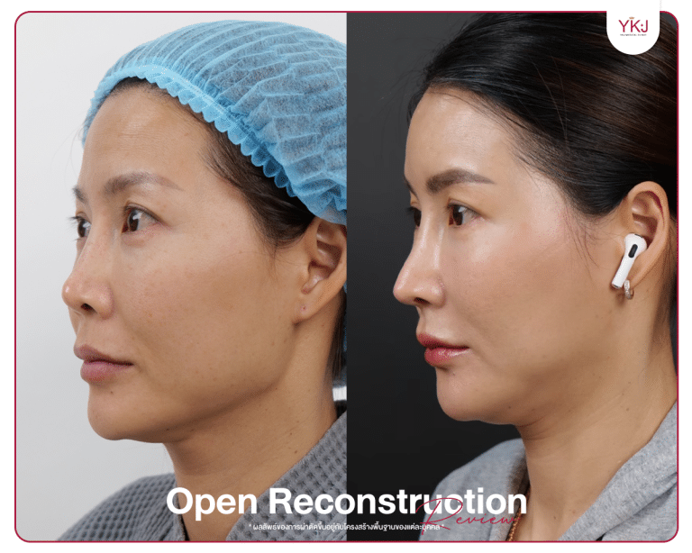 รีวิวแก้จมูก , รีวิวเสริมจมูกโอเพ่น , กระดูกซี่โครง , กระดูกอ่อนหลังหู