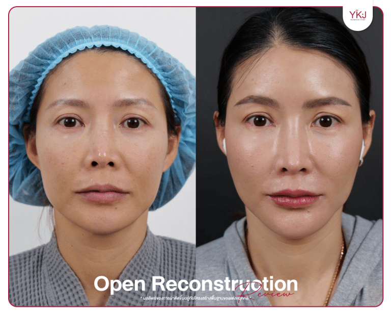 รีวิวแก้จมูก , รีวิวเสริมจมูกโอเพ่น , กระดูกซี่โครง , กระดูกอ่อนหลังหู