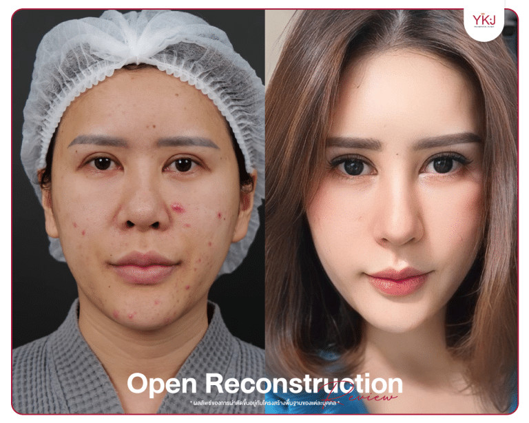 รีวิวแก้จมูก , รีวิวเสริมจมูกโอเพ่น , กระดูกซี่โครง , กระดูกอ่อนหลังหู