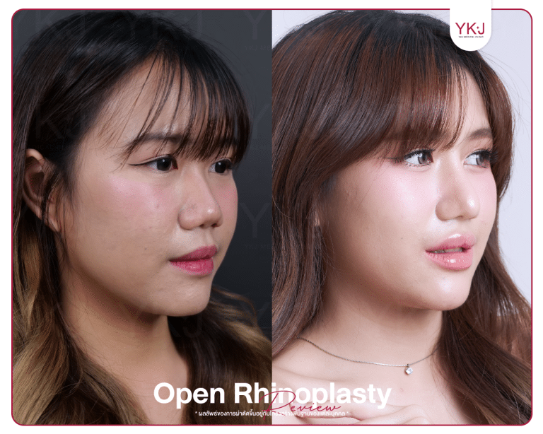 รีวิวแก้จมูก , รีวิวเสริมจมูกโอเพ่น , กระดูกซี่โครง , กระดูกอ่อนหลังหู