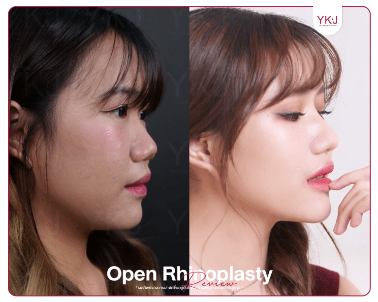 รีวิวแก้จมูก , รีวิวเสริมจมูกโอเพ่น , กระดูกซี่โครง , กระดูกอ่อนหลังหู