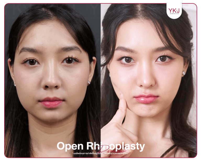 รีวิวแก้จมูก , รีวิวเสริมจมูกโอเพ่น , กระดูกซี่โครง , กระดูกอ่อนหลังหู