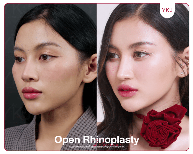 รีวิวแก้จมูก , รีวิวเสริมจมูกโอเพ่น , กระดูกซี่โครง , กระดูกอ่อนหลังหู